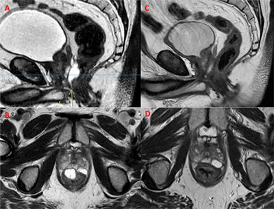 Case Report: Reversal of Hyaluronic Acid Rectal Wall Infiltration with Hyaluronidase